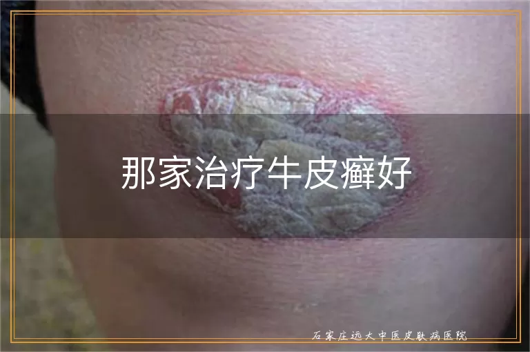 那家治疗牛皮癣好