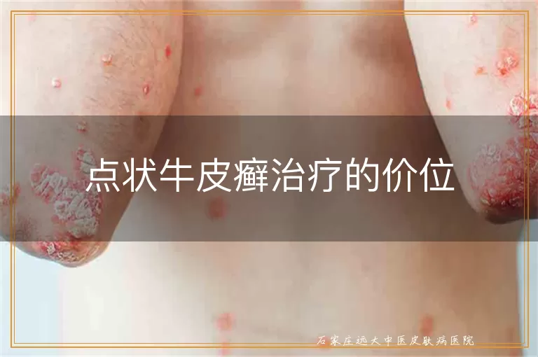 点状牛皮癣治疗的价位