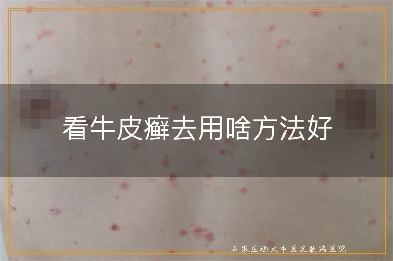 看牛皮癣去用啥方法好