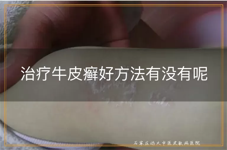 治疗牛皮癣好方法有没有呢