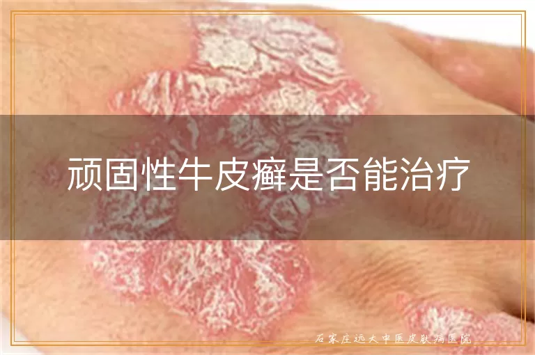顽固性牛皮癣是否能治疗