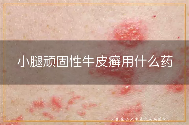小腿顽固性牛皮癣用什么药