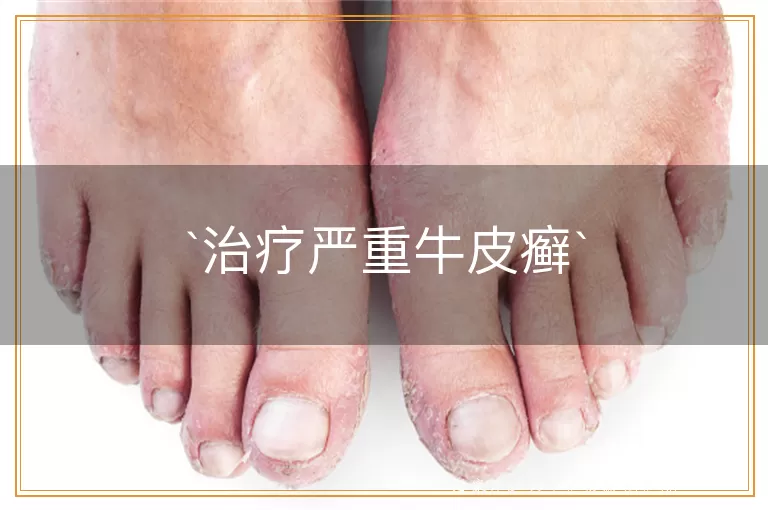 治疗严重牛皮癣