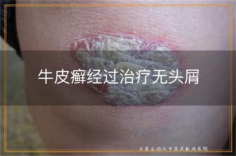 牛皮癣经过治疗无头屑