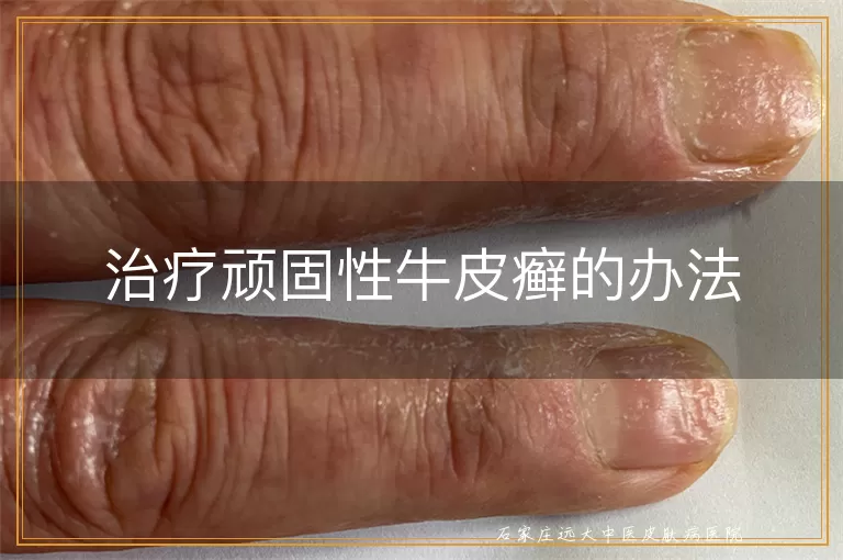 治疗顽固性牛皮癣的办法