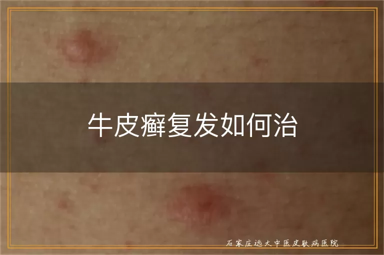 牛皮癣复发如何治