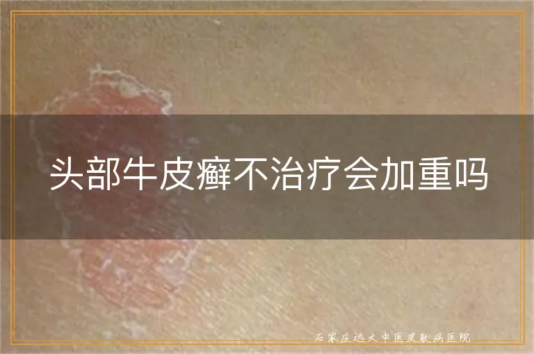 头部牛皮癣不治疗会加重吗