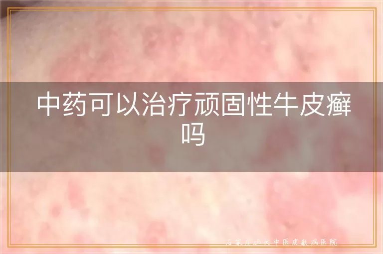 中药可以治疗顽固性牛皮癣吗