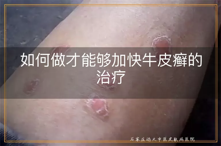 如何做才能够加快牛皮癣的治疗