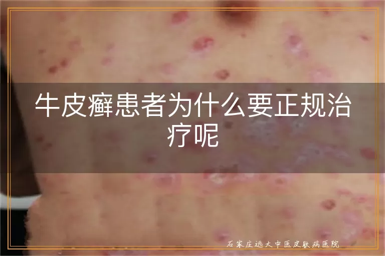 牛皮癣患者为什么要正规治疗呢