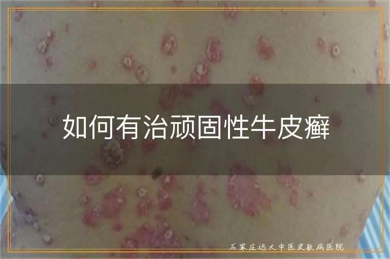 如何有治顽固性牛皮癣