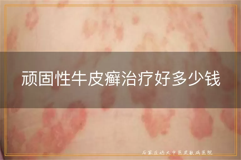 顽固性牛皮癣治疗好多少钱