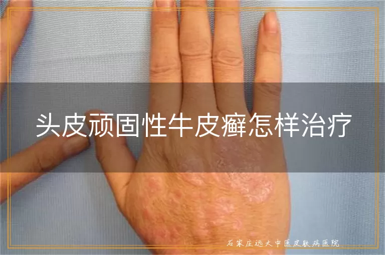 头皮顽固性牛皮癣怎样治疗