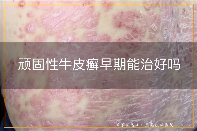 顽固性牛皮癣早期能治好吗