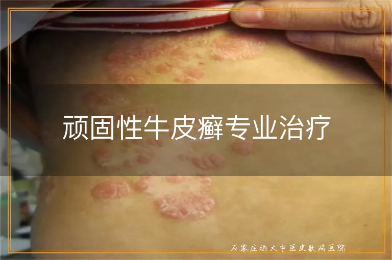 顽固性牛皮癣专业治疗