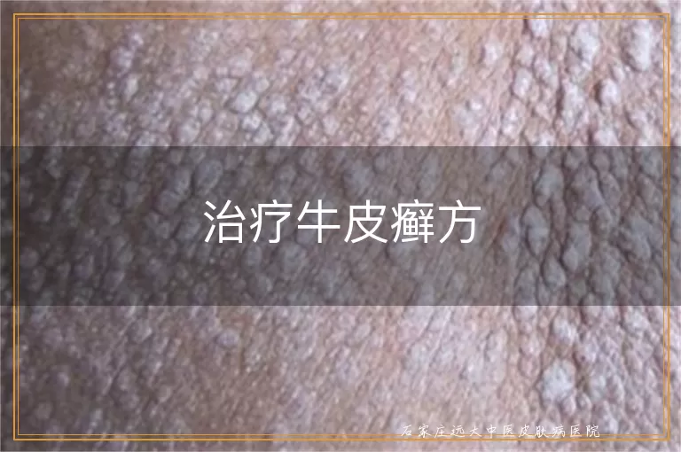 治疗牛皮癣方
