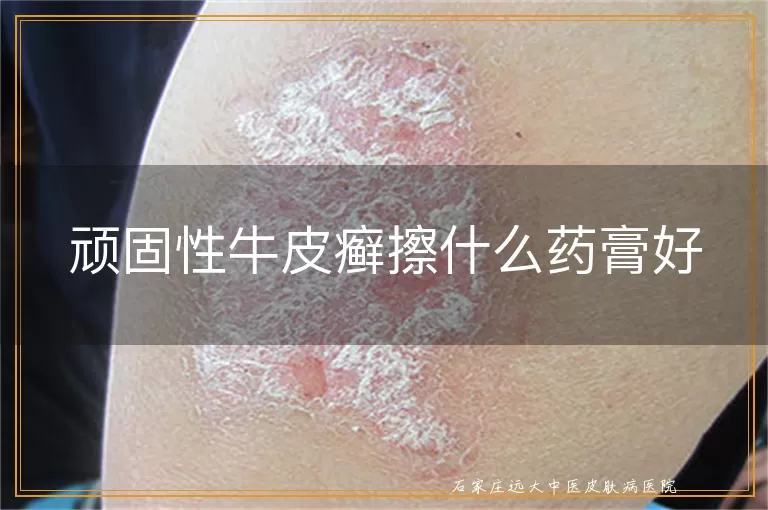 顽固性牛皮癣擦什么药膏好