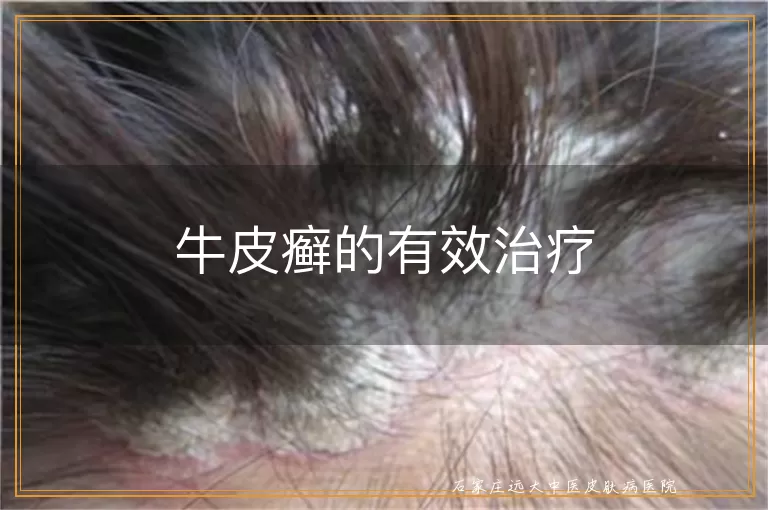 牛皮癣的有效治疗