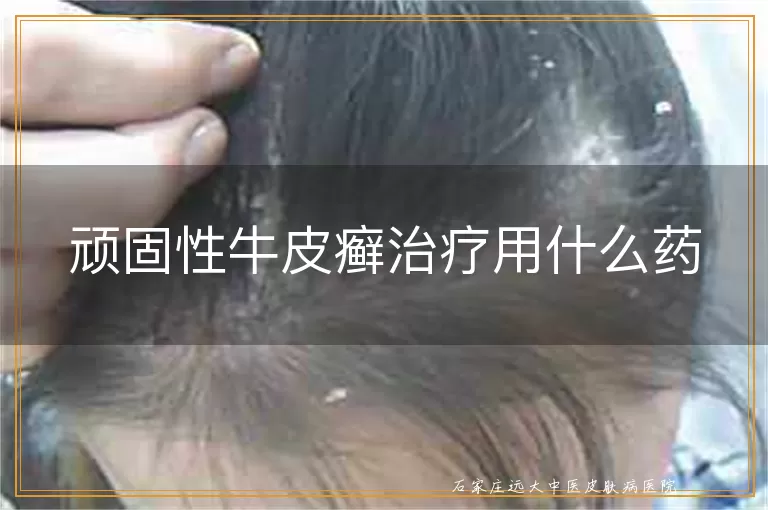 顽固性牛皮癣治疗用什么药