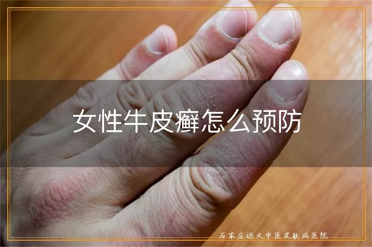 女性牛皮癣怎么预防