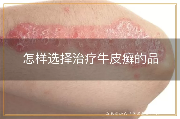 怎样选择治疗牛皮癣的品