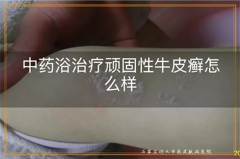 中药浴治疗顽固性牛皮癣怎么样