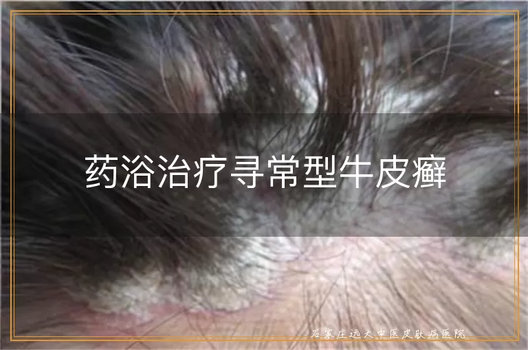 药浴治疗寻常型牛皮癣
