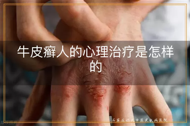 牛皮癣人的心理治疗是怎样的
