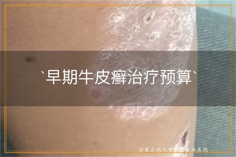 早期牛皮癣治疗预算