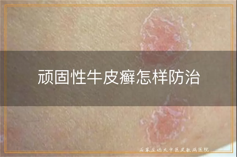 顽固性牛皮癣怎样防治