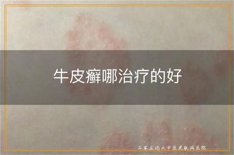 牛皮癣哪治疗的好