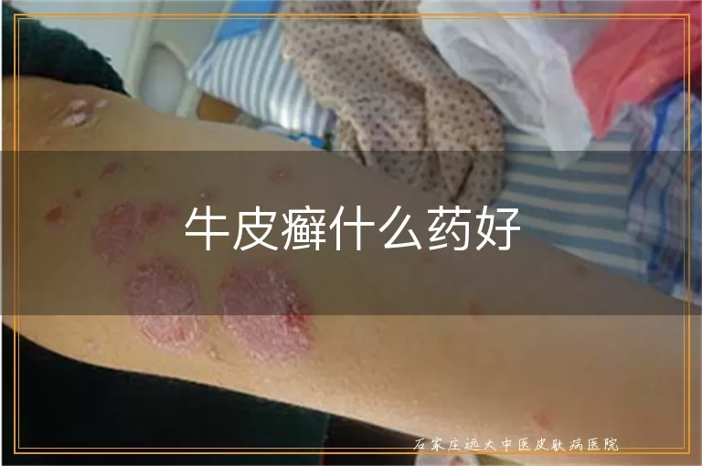 牛皮癣什么药好