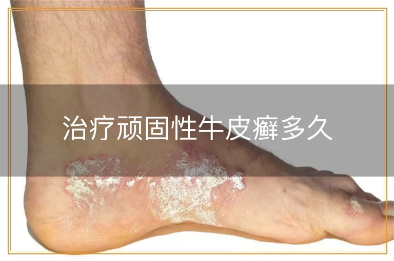 治疗顽固性牛皮癣多久