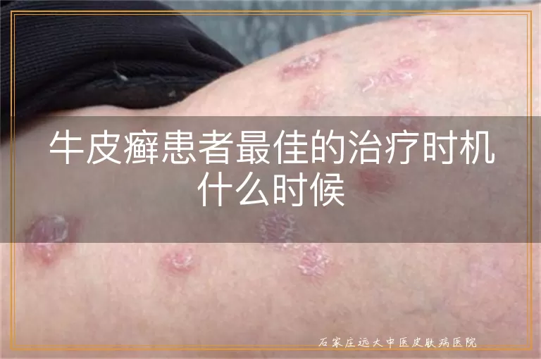 牛皮癣患者最佳的治疗时机什么时候