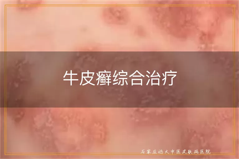 牛皮癣综合治疗