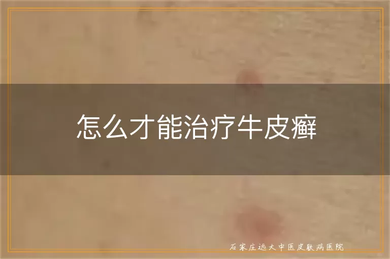 怎么才能治疗牛皮癣