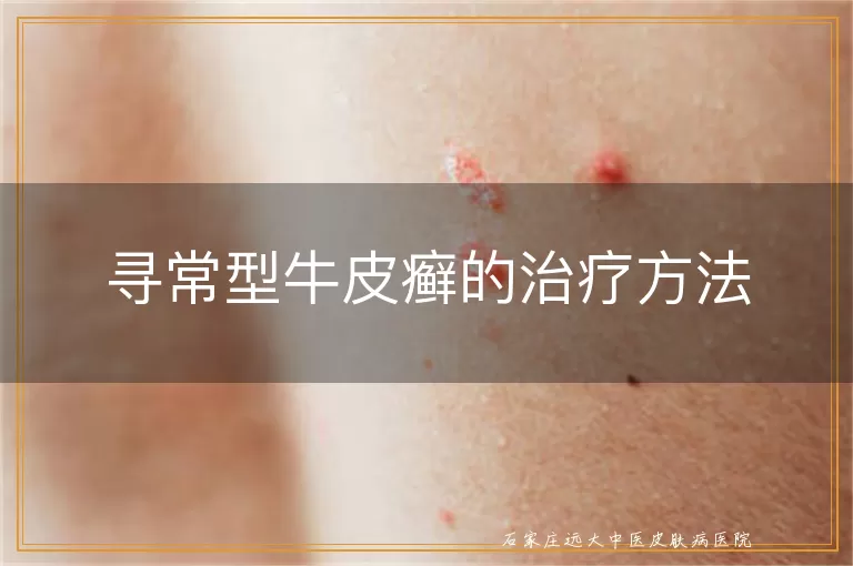 寻常型牛皮癣的治疗方法