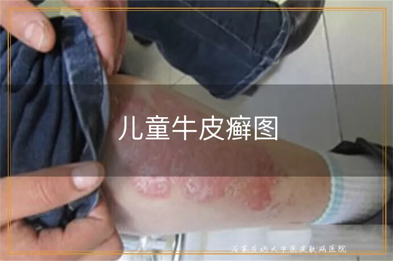 儿童牛皮癣图