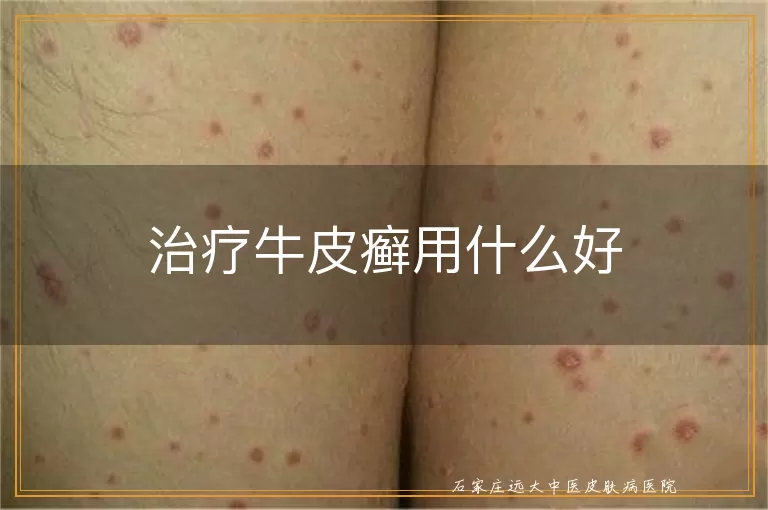 治疗牛皮癣用什么好