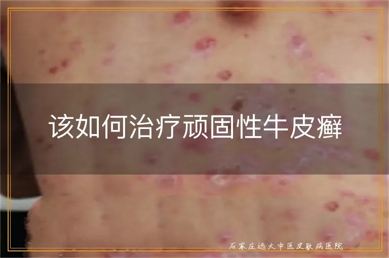该如何治疗顽固性牛皮癣