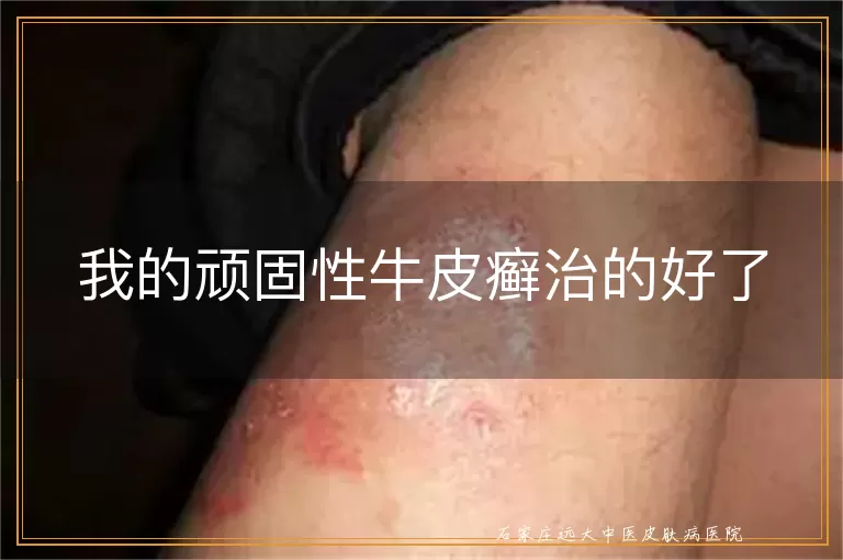 我的顽固性牛皮癣治的好了