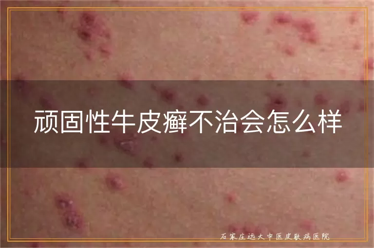 顽固性牛皮癣不治会怎么样