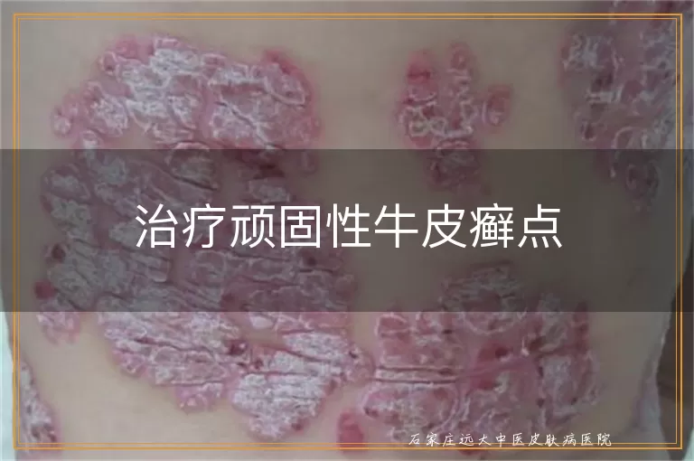 治疗顽固性牛皮癣点