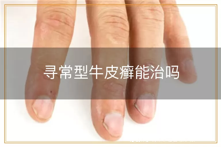 寻常型牛皮癣能治吗