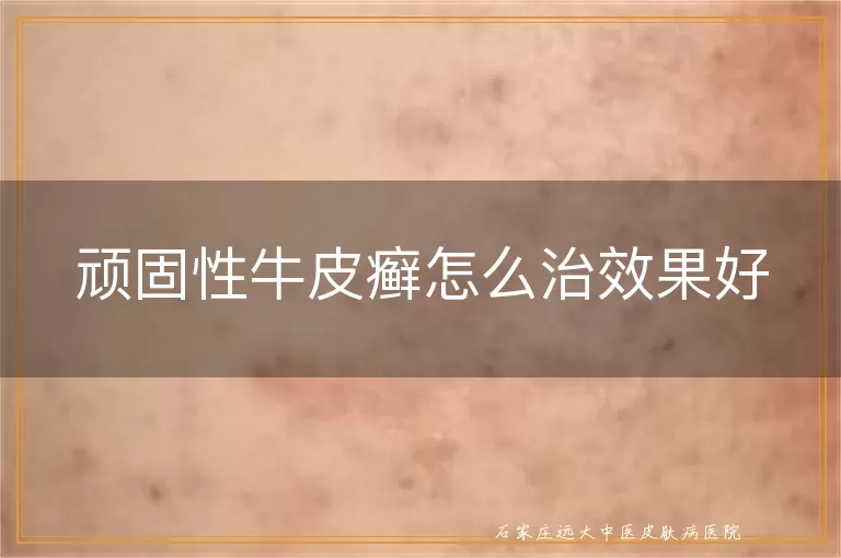 顽固性牛皮癣怎么治效果好
