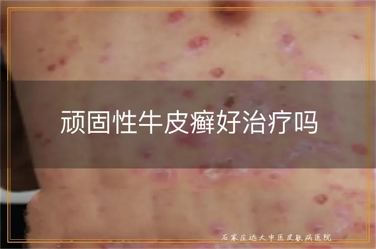 顽固性牛皮癣好治疗吗