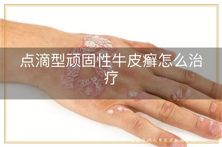 点滴型顽固性牛皮癣怎么治疗