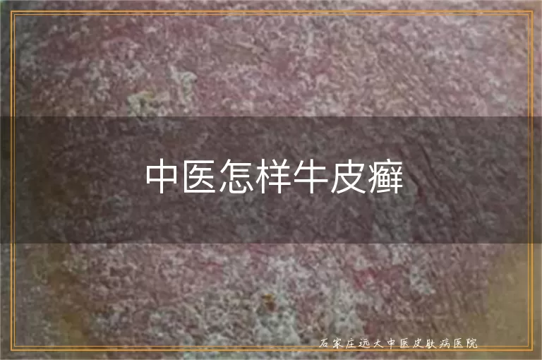中医怎样牛皮癣