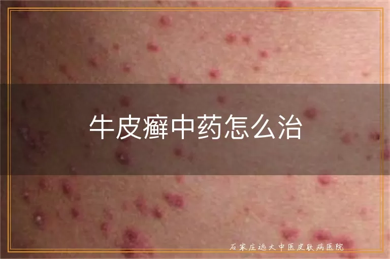 牛皮癣中药怎么治