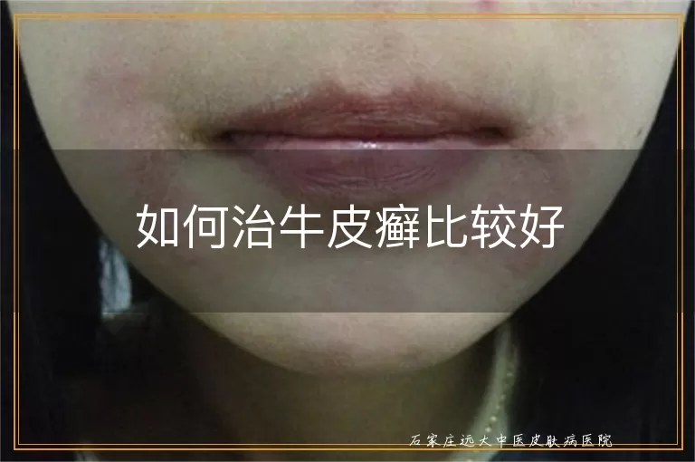 如何治牛皮癣比较好